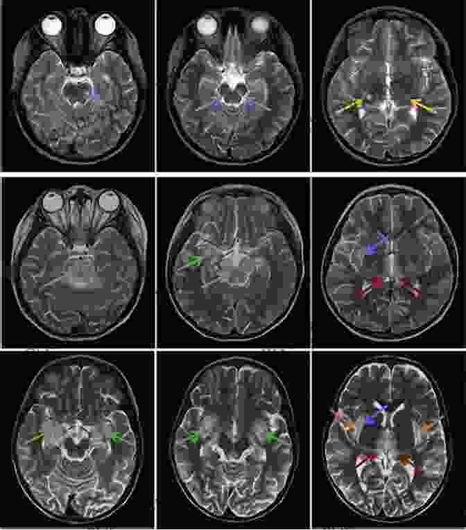 Image Of A Brain Scan With Abnormal Activity Patterns Defining Autism: A Guide To Brain Biology And Behavior